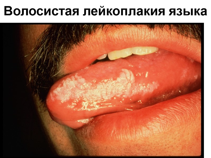 Волосистая лейкоплакия языка